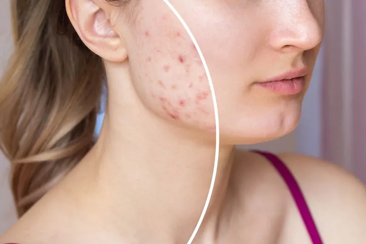 Top Ingredients That Actually Work for Acne-Prone Skin